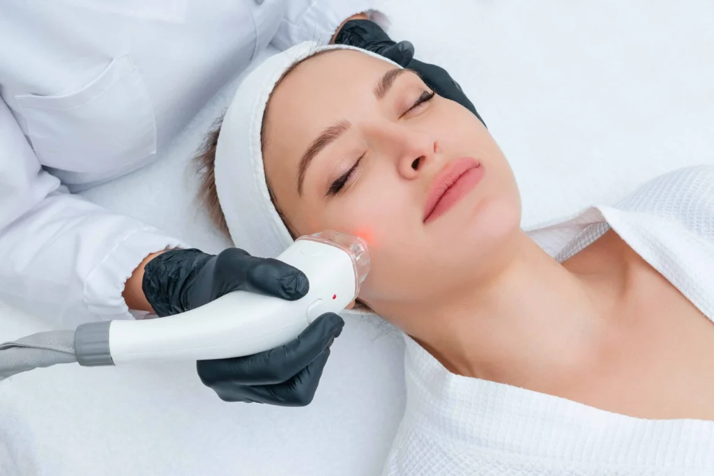 CoolPeel Laser Treatment in Raleigh, NC