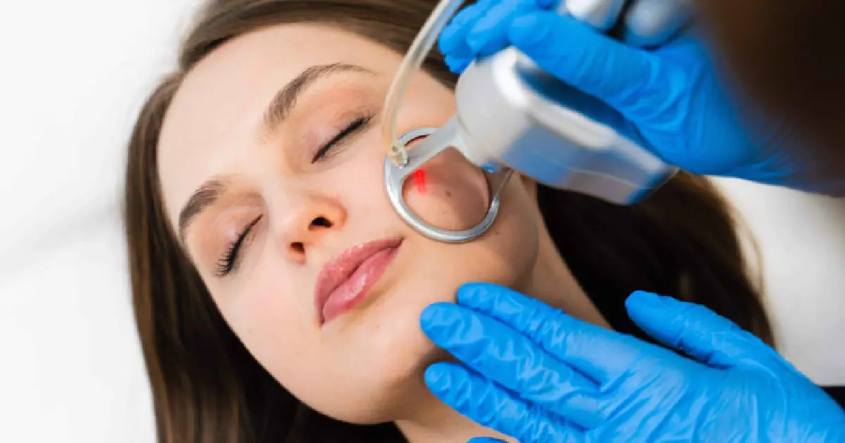 Deka CO2 Laser Treatment in Raleigh, NC