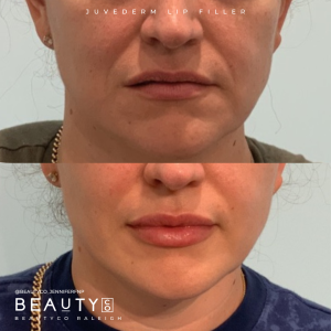 Lip Filler by Jennifer Turner