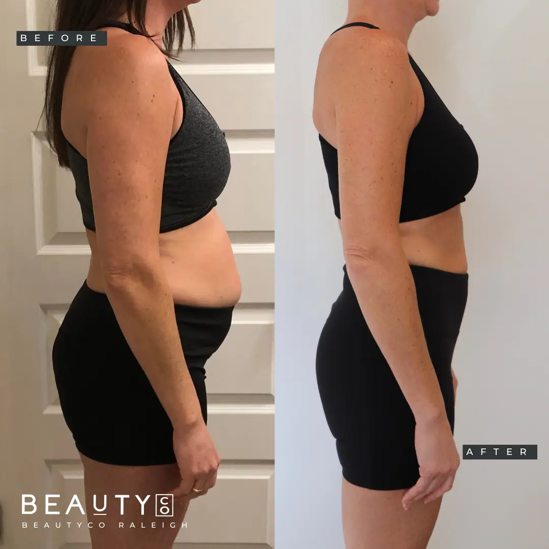 Medical Weight Loss Before and After